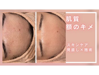 シャルナ(charna)/肌質の変化