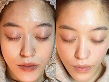 ミエリア美容鍼灸院(mielia美容鍼灸院)/カスタム美容鍼灸30本＋毛穴洗浄
