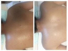 ダルセーニョ/背中トリートメント&パック