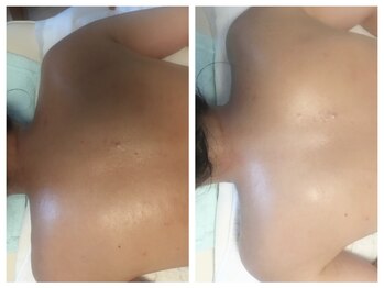 ダルセーニョ/背中トリートメント&パック