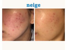 ネージュ(neige)/よもぎ蒸しで《肌荒れ》改善