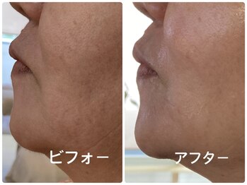 ノーブル シャット Noble Chate/何かが違うビフォーアフター