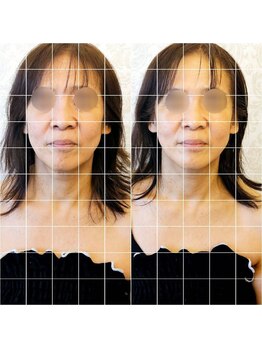 ディーバ 北浜(Diva)/毛穴洗浄付き！韓国小顔コルギ