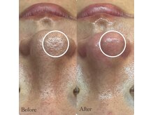 ピエル 北千住店(PIEL)/毛穴美人への道