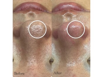 ピエル 北千住店(PIEL)/毛穴美人への道