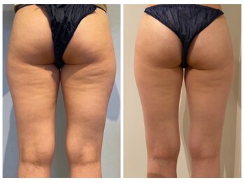 ルナグランデ 心斎橋店(Luna grande.)/内ももにも効果的