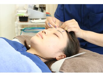 おざき鍼灸接骨院/顔面鍼の施術