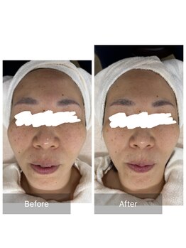 MTサロン 飯塚店/フェイスラインスッキリ！！