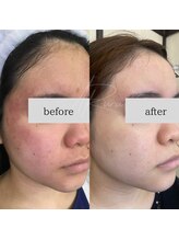 アルル(ARuru)/肌改善症例　