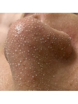 んまち/韓国式3D毛穴洗浄