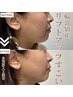 人気No.１☆切らないエアリフト　水光注入＋高濃度酸素￥3850