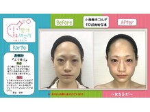 小顔整体研究所 KSラボ 鳴海店/比較写真５