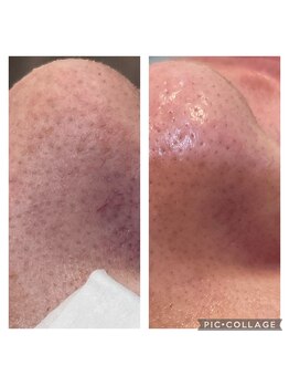 ルナート(Lunart)/毛穴洗浄/毛穴ケア