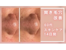 シャルナ(charna)/開き毛穴改善