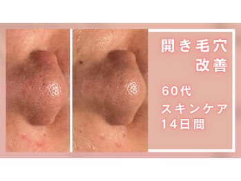 シャルナ(charna)/開き毛穴改善