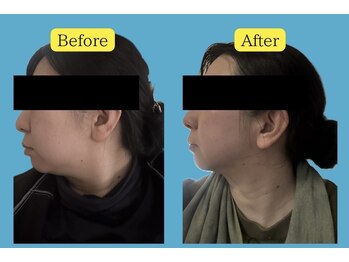 ヨサパーク ピュアン(YOSA PARK)/水素まみれ美痩身コース