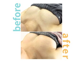 シエル(Ciel)/バストアップ施術１回