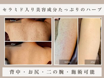 ビビ(VIVI)の写真/【ハーブピーリング背中】艶肌背中コース120分￥9600◇福岡希少のボディ対応ハーブピーリングで背中美人に