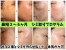  【他院でシミ改善叶わなかった方必見！！】シミ改善プログラムのご相談に◎