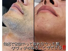 ダヴィデ(DAVID)の雰囲気（難しいアゴ先もスッキリつるつる）
