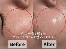 バタフライ 平塚店(Butterfly)/40代加齢による開き毛穴の改善