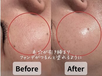 バタフライ 平塚店(Butterfly)/40代加齢による開き毛穴の改善