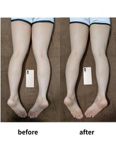 代官山アサ接骨院 鍼灸院(代官山 Asa 接骨院 鍼灸院)/足のむくみ/血流改善/足スッキリ