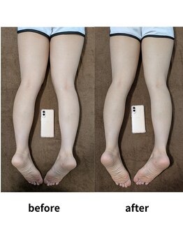 代官山アサ接骨院 鍼灸院(代官山 Asa 接骨院 鍼灸院)/足のむくみ/血流改善/足スッキリ