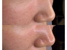 ル シーニュ/毛穴エクストラクション