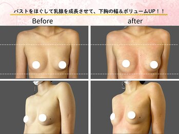 ロットプラス(Lot Plus)/バストアップ症例【C→Fカップ】