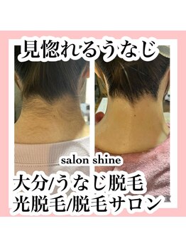 サロンシャイン(Salon Shine)/うなじ脱毛１０代後半女性