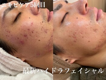 メディカルサロン フィオレ(fiore)/ハイドラフェイシャルニキビケア