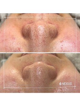 ネクサス(NEXUS)/黒ずみを放置しないで