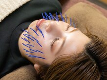 ボニー(Bonnie)/小顔矯正/美容鍼灸で憧れ小顔に!