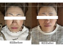 ダイアリー(DIARY)/小顔矯正