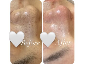 ボヌール バイ ユニ(bonHeuR by uni.)/究極の毛穴ケア