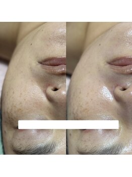 サロン フィオーレ(salon fiore)の写真/レチノールピーリングで毛穴・たるみケア!目指すは、内側から輝くハリツヤ肌へ♪