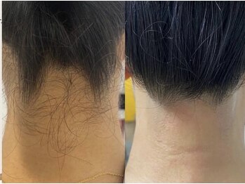 みんなの脱毛 ツルリン(TSURURIN)/施術例【脱毛/市川/千葉】