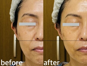 メナードフェイシャルサロン 西五反田/小顔/引き上げ/シワタルミ