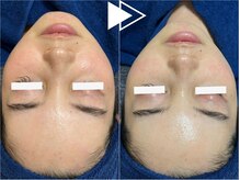 リシェス(Richesse)/水光ピーリング★初回¥9990