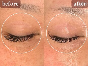 トータルセラピー リッチ(Rich)/50代　目元のシワ改善