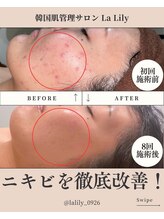 ラリリー(La Lily)/ニキビにはもう悩まない！