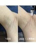 ピンセットで一本ずつ抜くのは卒業◎夏前の準備に! 両ワキ 光脱毛 ¥2,000