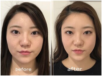 ビー バランス(Be.BALANCE)/【ダイヤモンド小顔矯正】