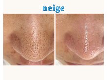 ネージュ(neige)/よもぎ蒸しで《いちご鼻》改善