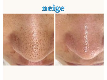 ネージュ(neige)/よもぎ蒸しで《いちご鼻》改善