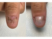 ナイズネイル(Ny's Nail)の雰囲気（長年悩み生えてこなかった爪も深爪矯正で伸びました☆）