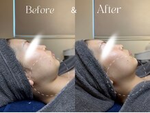 アイシス(AIsis)/【小顔/たるみ】LDMハイプレ