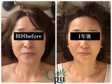 キュープ 福岡天神店(Qpu)/オイルコース１２回での変化