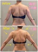 エクセレントビューティーサロン 艶(EN)/ブライダル　お背中集中